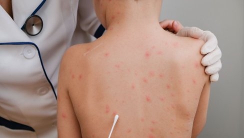 JOŠ JEDAN SLUČAJ MALIH BOGINJA U BEOGRADU: Dečak (8) nije primio nijednu vakcinu