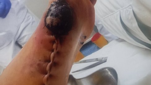 UHAPŠEN DOKTOR I KOZMETIČAR ORDINACIJE BEOMEDIKUS BEOGRAD: Pacijentu lečili stopalo, pa napravili teški deformitet (FOTO)
